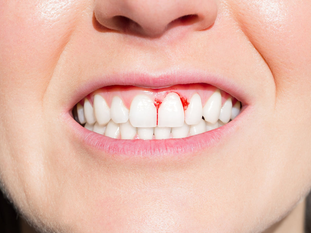 Anwendung von Propolis bei Zahnfleischentzündung