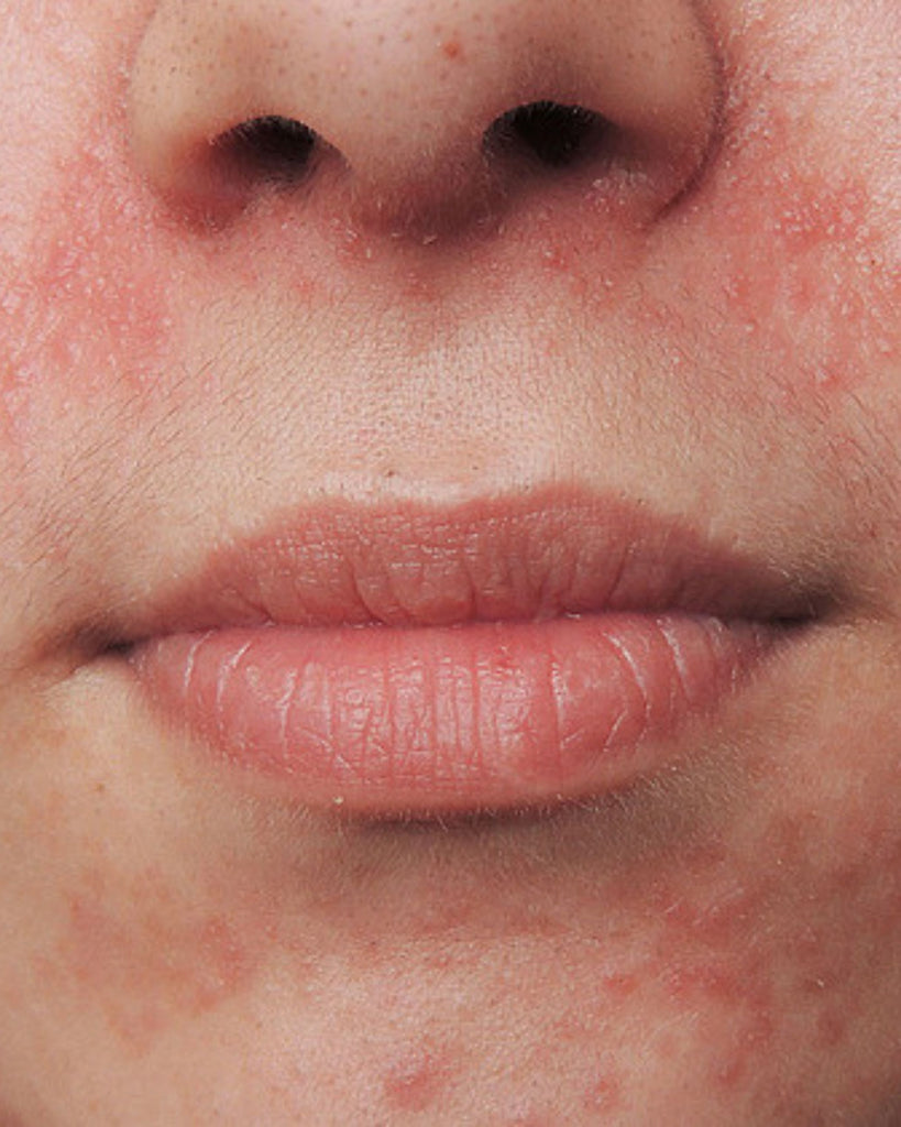 Periorale Dermatitis – bedrop.de